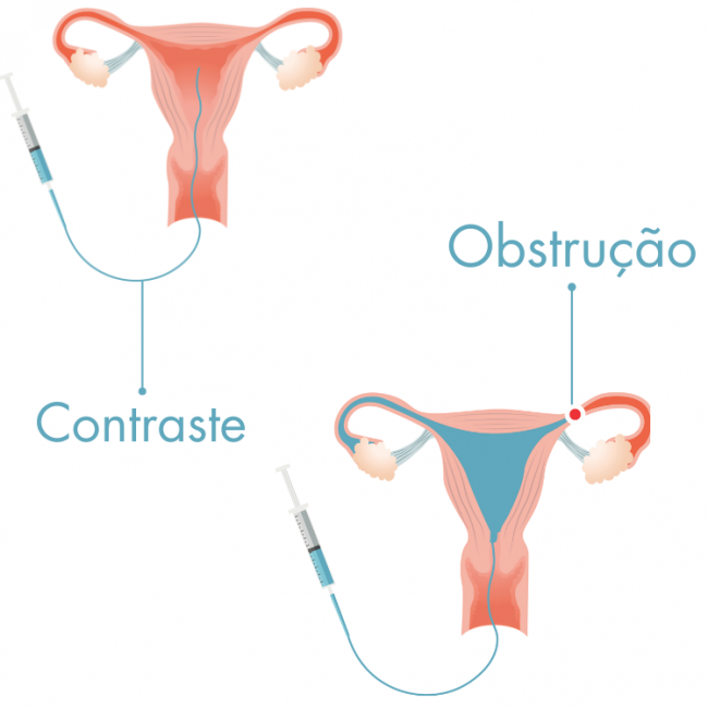 hsg exame constraste